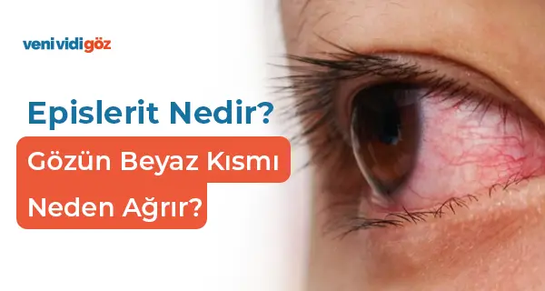 Episklerit Nedir? Gözün Beyaz Kısmı Neden Ağrır