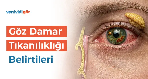 Göz Damar Tıkanıklığı Belirtileri, Nedenleri ve Tedavisi