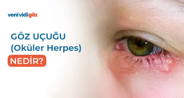 Göz Uçuğu (Oküler Herpes) Nedir, Belirtileri ve Evde Tedavi Yöntemleri