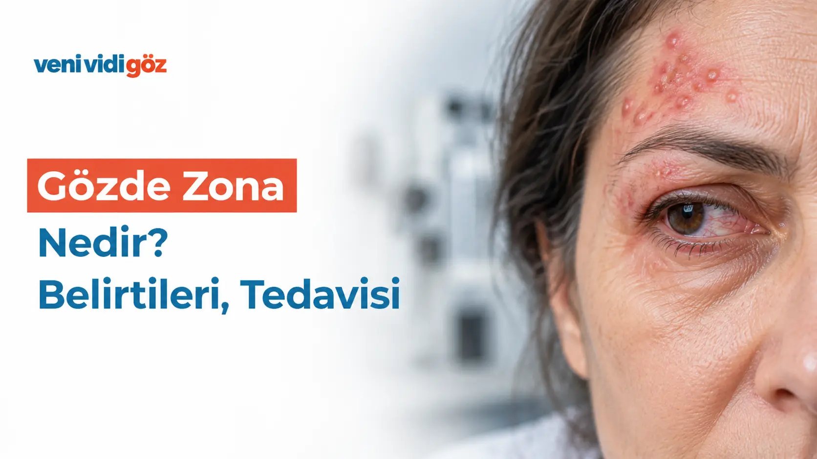 Gözde Zona Nedir? Belirtileri, Tedavisi