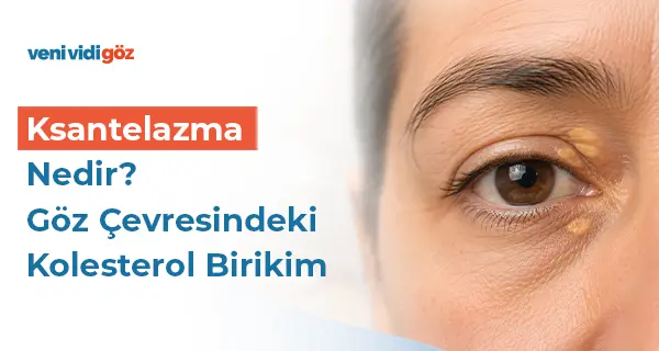 Ksantelazma Nedir? Göz Çevresindeki Kolesterol Birikim