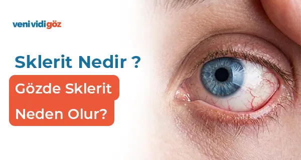 Sklerit Nedir ? Gözde Sklerit Neden Olur?