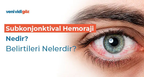 Subkonjonktival Hemoraji Nedir? Belirtileri Nelerdir?