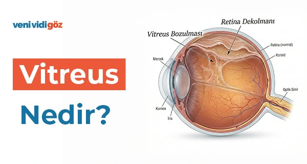 Vitreus Nedir? Vitreus Dejenerasyonu, Hemorajisi ve Gözde Oluşturduğu Belirtiler
